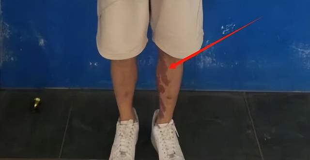 布星星全身照腿部伤痕惊心更多受害家属发声龙8国际电子游戏娱乐平台营救神速！泰方公(图6)